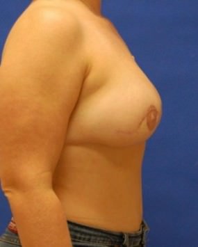 Breast Reconstruction