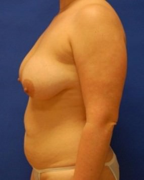 Breast Reconstruction