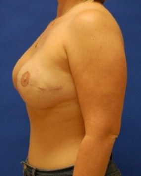 Breast Reconstruction