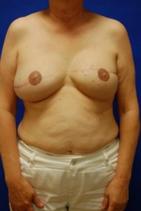 Breast Reconstruction