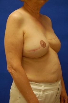 Breast Reconstruction