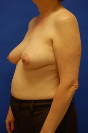 Breast Reconstruction