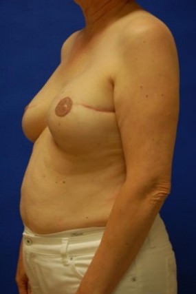 Breast Reconstruction