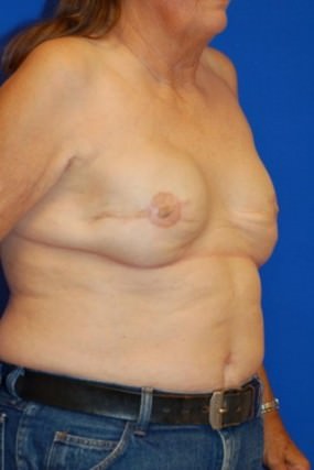 Breast Reconstruction