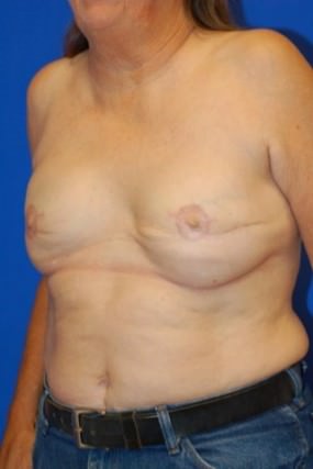 Breast Reconstruction