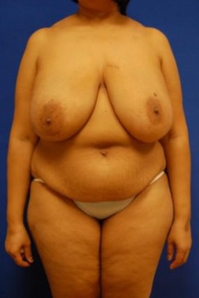 Breast Reconstruction