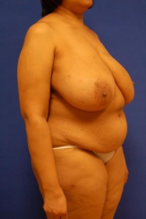 Breast Reconstruction