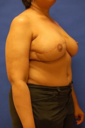 Breast Reconstruction