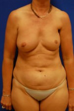 Breast Reconstruction