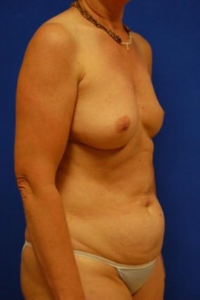 Breast Reconstruction