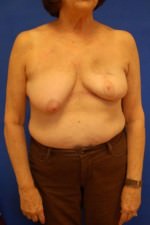 Breast Reconstruction