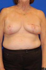 Breast Reconstruction