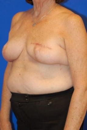 Breast Reconstruction