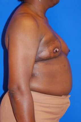 Breast Reconstruction Case 2977- Breast Reconstruction After Photo Breast Reconstruction