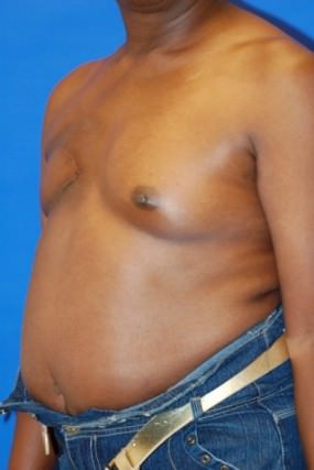 Breast Reconstruction Case 2977- Breast Reconstruction Before Photo Breast Reconstruction