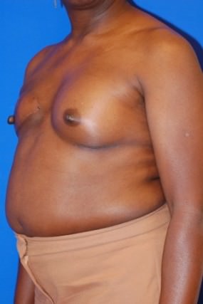 Breast Reconstruction Case 2977- Breast Reconstruction After Photo Breast Reconstruction