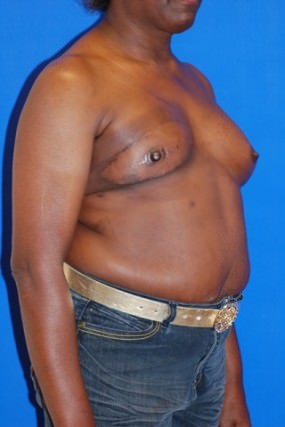 Breast Reconstruction Case 2977- Breast Reconstruction Before Photo Breast Reconstruction