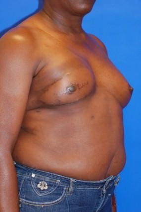 Breast Reconstruction Case 2977- Breast Reconstruction After Photo Breast Reconstruction