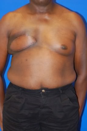 Breast Reconstruction Case 2977- Breast Reconstruction After Photo Breast Reconstruction