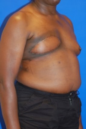 Breast Reconstruction Case 2977- Breast Reconstruction After Photo Breast Reconstruction