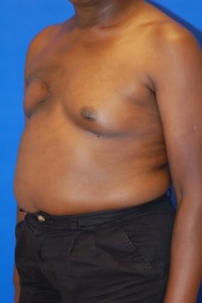Breast Reconstruction Case 2977- Breast Reconstruction After Photo Breast Reconstruction