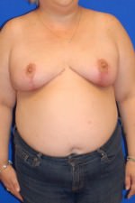 Breast Reduction