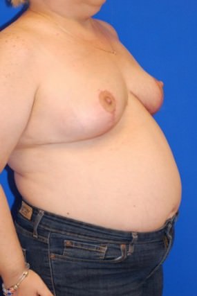 Breast Reduction