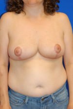 Breast Reduction