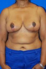Breast Reduction