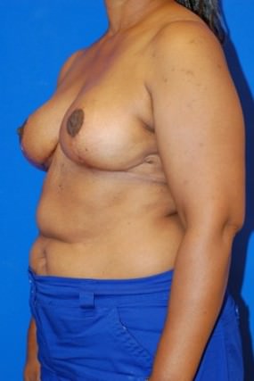 Breast Reduction