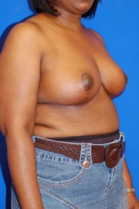 Breast Reduction
