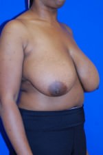 Breast Reduction