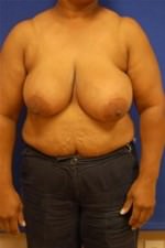 Breast Reduction