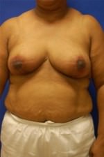 Breast Reduction