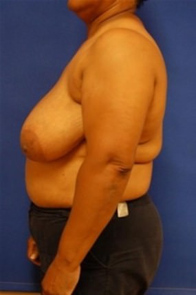 Breast Reduction