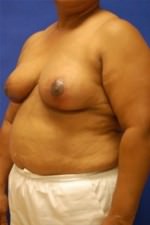 Breast Reduction