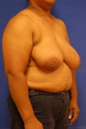 Breast Reduction