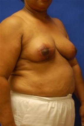 Breast Reduction