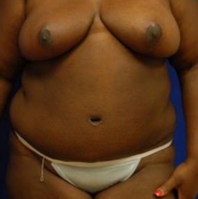 Breast Reduction