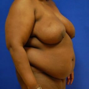 Breast Reduction