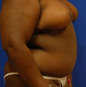 Breast Reduction