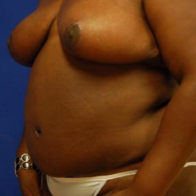 Breast Reduction