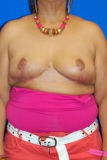 Breast Reduction
