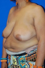 Breast Reduction