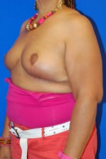 Breast Reduction