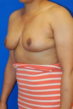 Breast Reduction