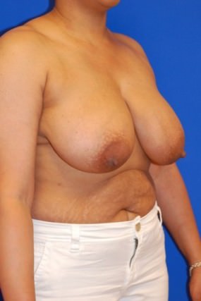 Breast Reduction