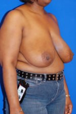 Breast Reduction