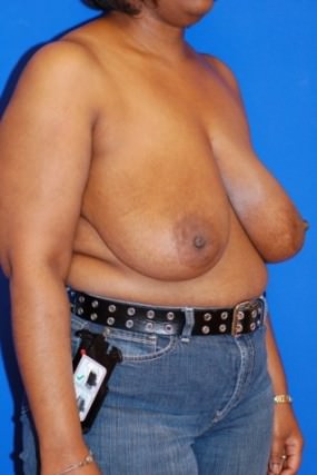 Breast Reduction