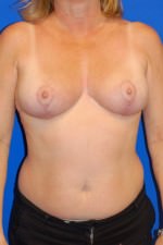 Breast Reduction